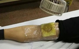 被黃胡蜂蟄了怎么辦，遠(yuǎn)離蜂巢后再用弱酸性溶液清洗傷處